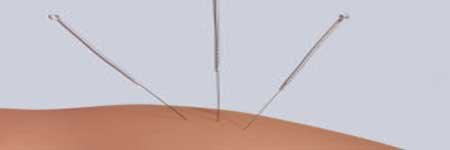 Acupuncture